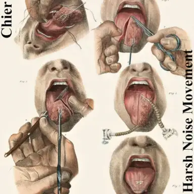 Ankyloglossia