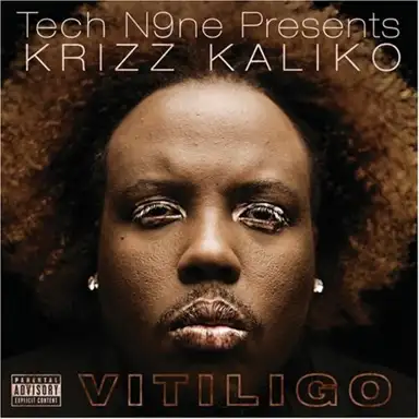 Vitiligo