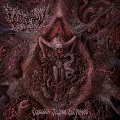 Aberrant Vaginal Gestation